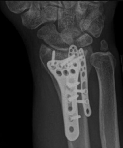Complex Radius Fixation