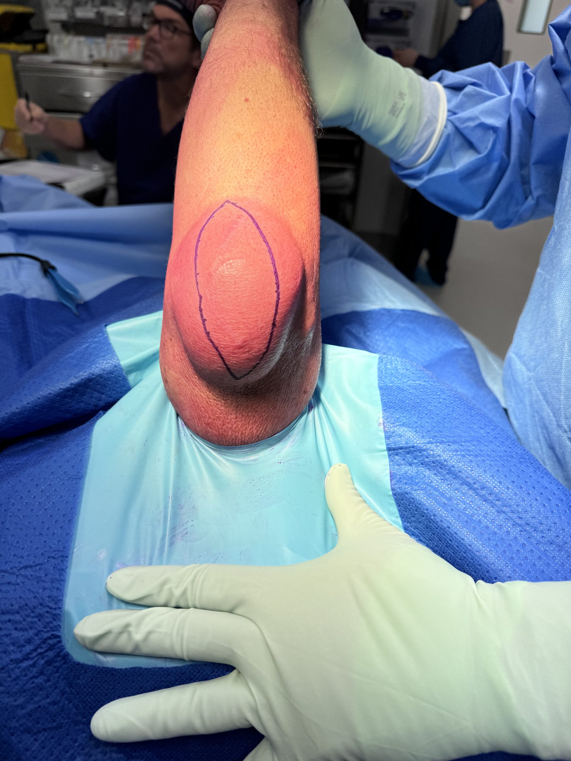 Olecranon bursitis