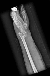 Example of Smiths fracture