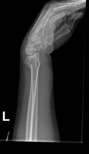 Example of Colles fracture