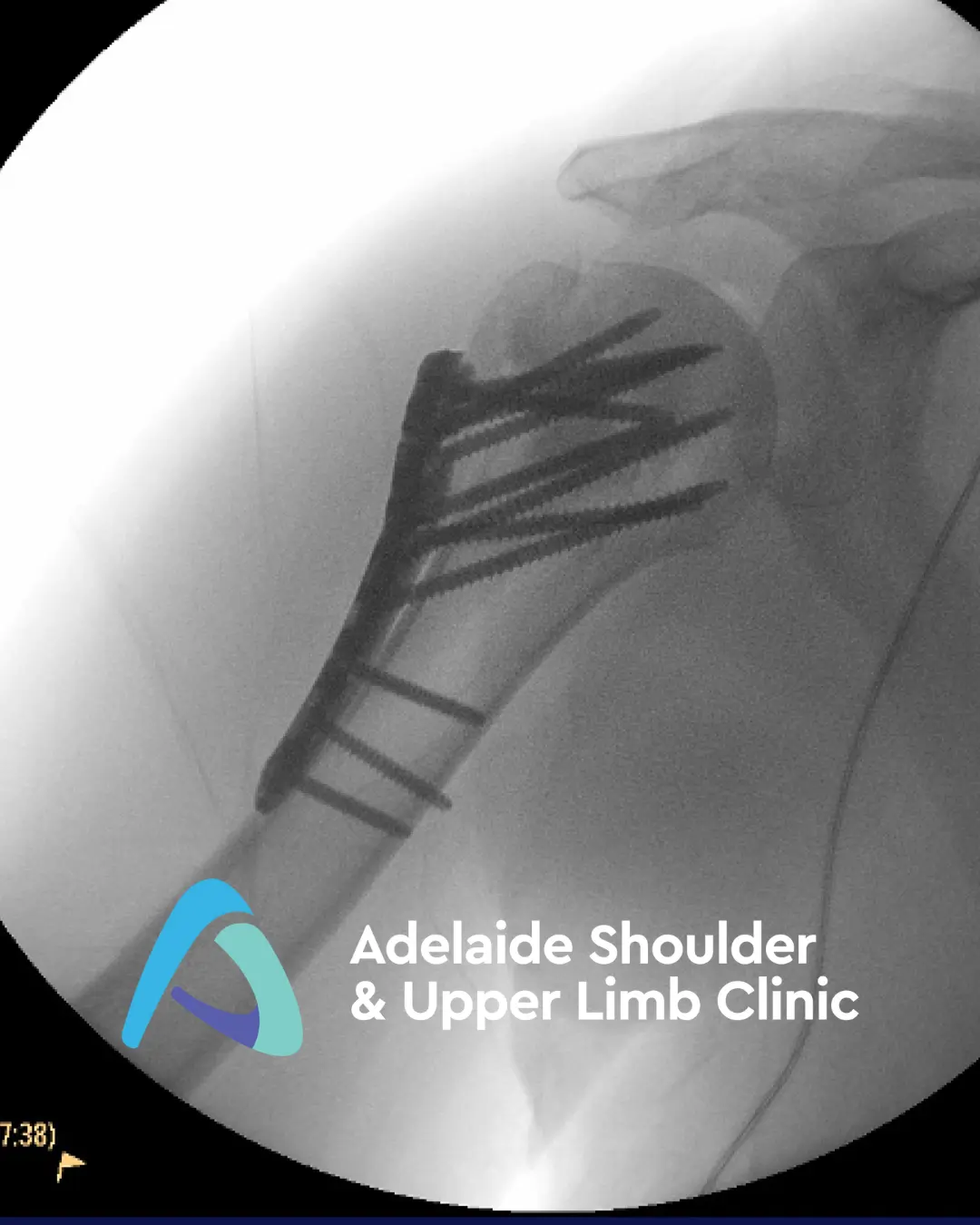 Proximal Humerus Fracture | Dr Oscar Brumby-Rendell | ASULC | Adelaide Shoulder & Upper Limb Clinic