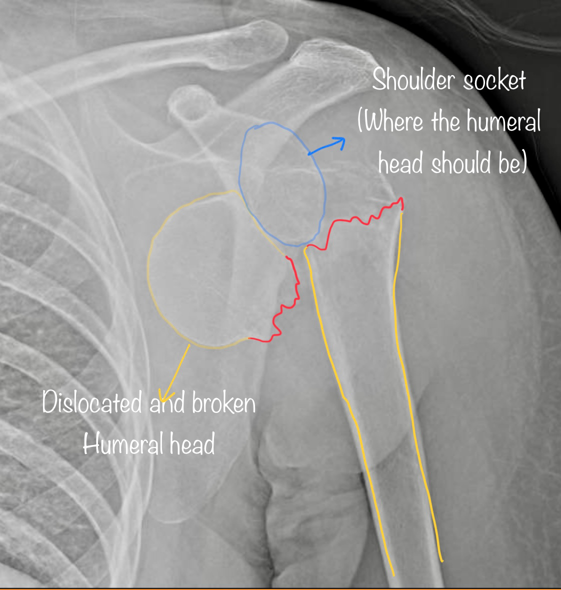 Proximal humerus fracture dislocation