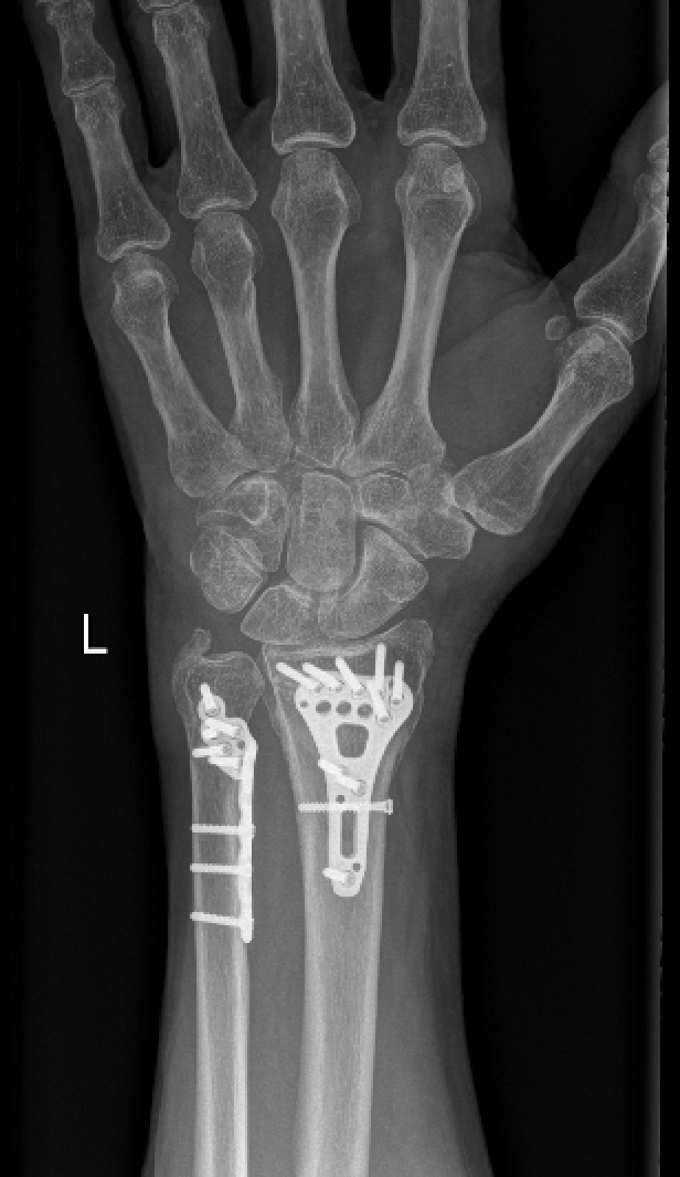Radius and Ulna Fixation