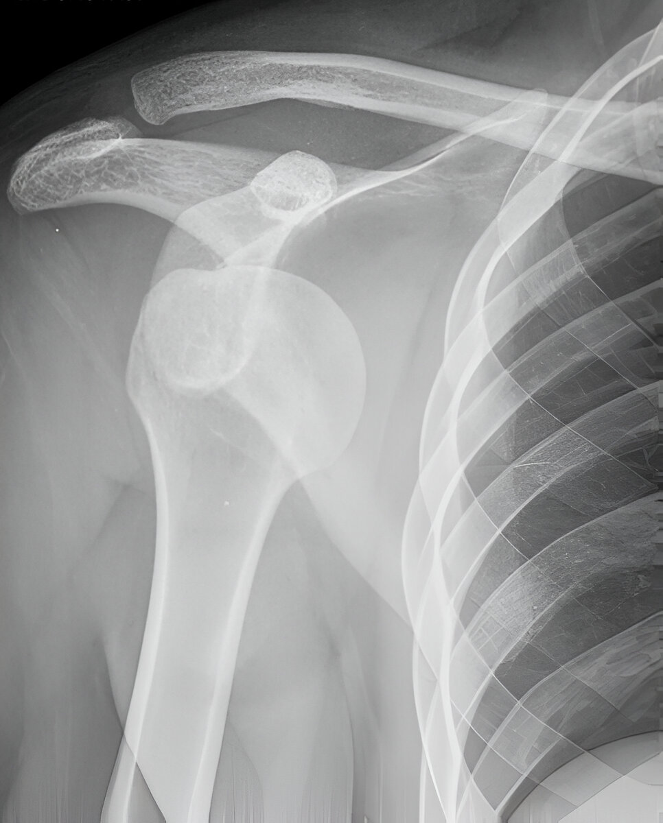 Shoulder Dislocation Xray