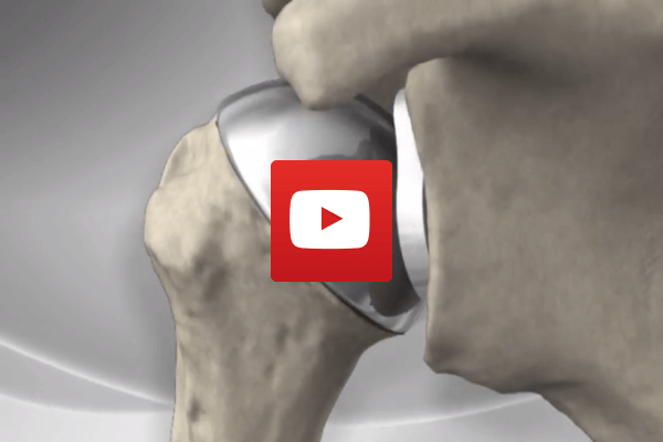 Dr Oscar Brumby-Rendell | ASULC | Adelaide Shoulder & Upper Limb Clinic | Shoulder Replacement Surgery