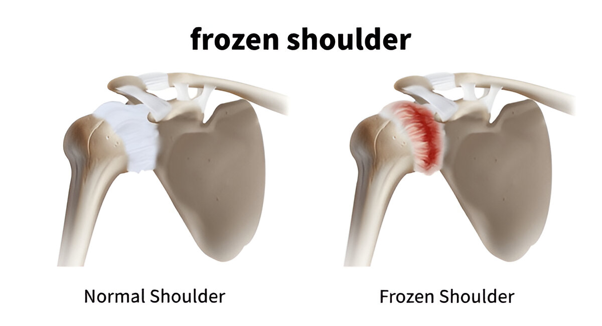 frozen shoulder