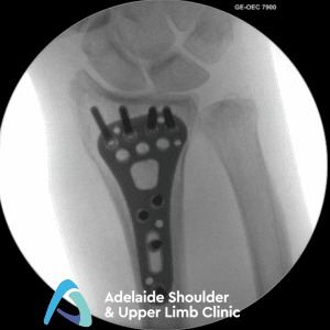 Fixation of distal radius fracture with plate and screws - allowing early motion