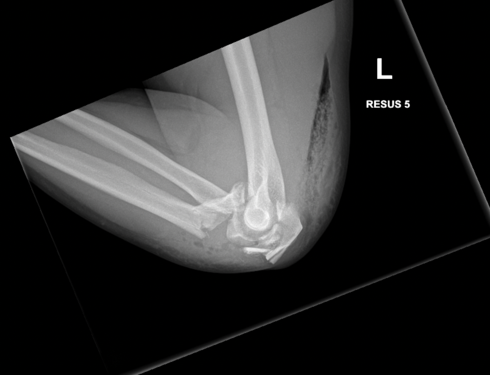 Elbow fracture dislocations 4
