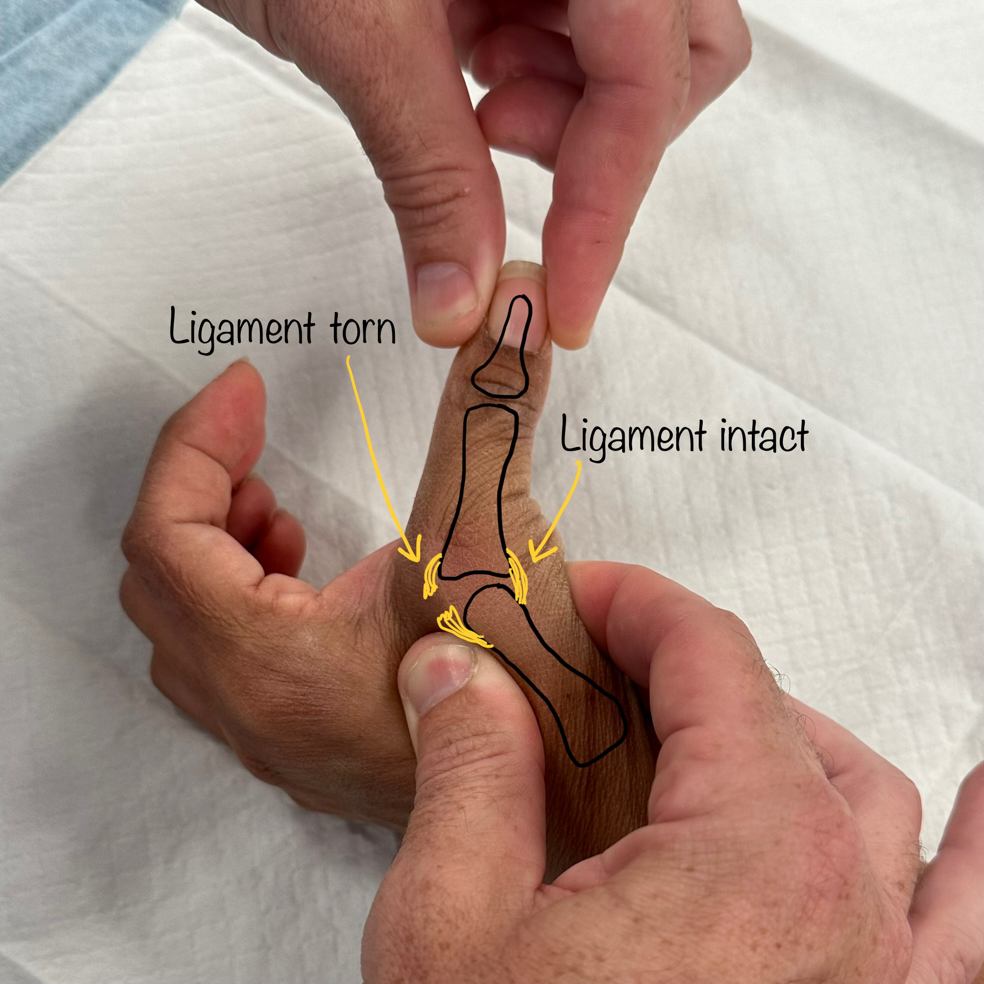 Thumb ligament (skiers thumb)