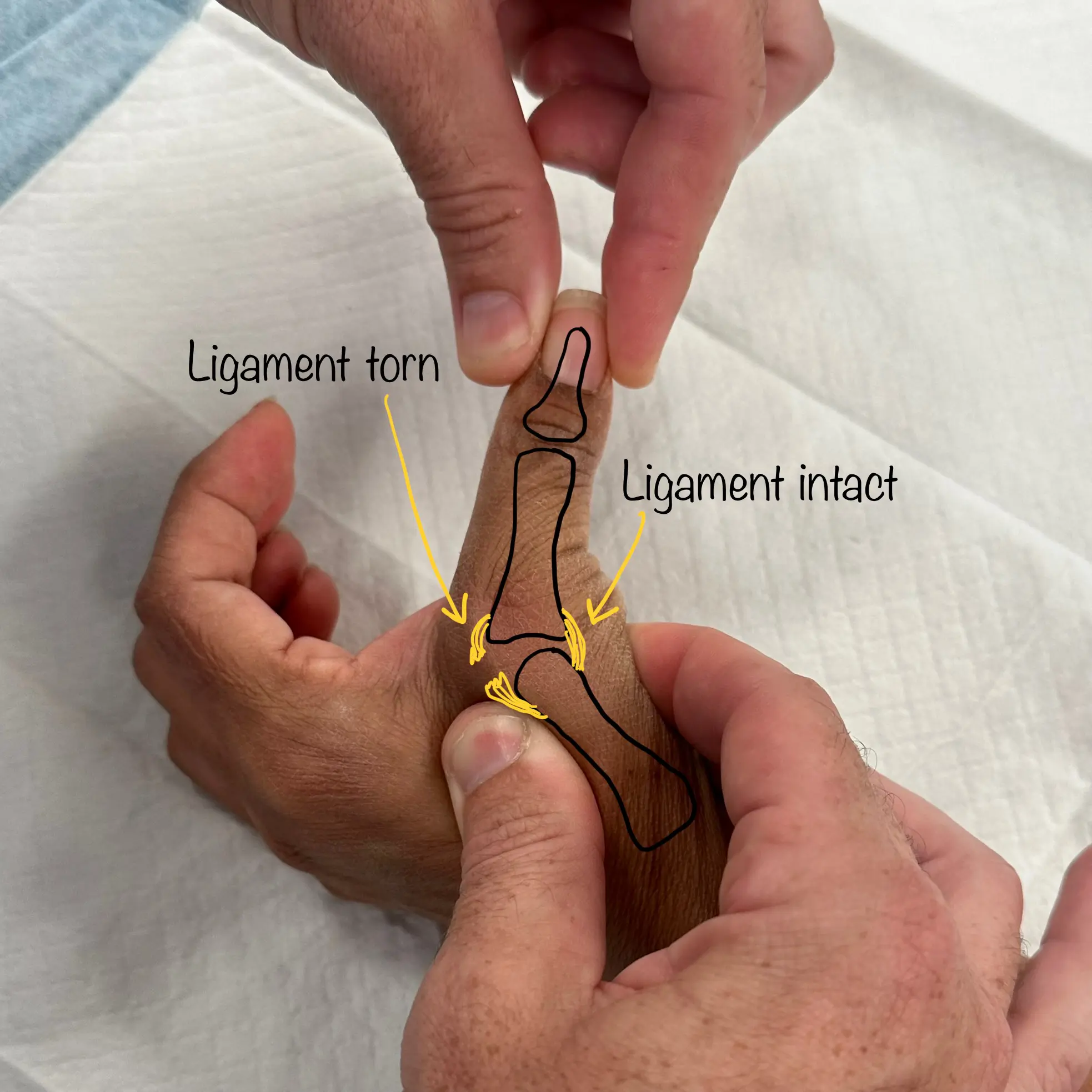 Skiers Thumb | Dr Oscar Brumby-Rendell | ASULC | Adelaide Shoulder & Upper Limb Clinic
