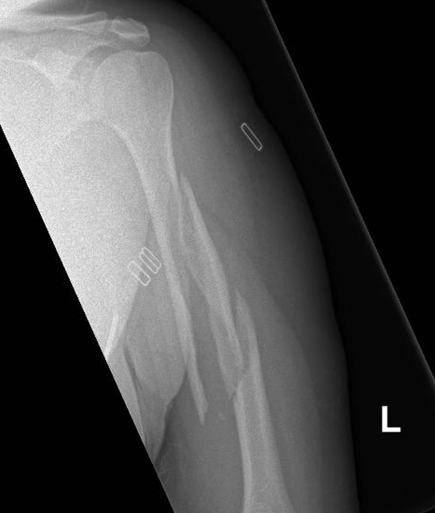 Humeral Shaft Fractures