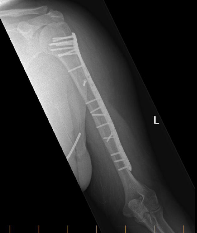 Humeral Shaft Fracture 2