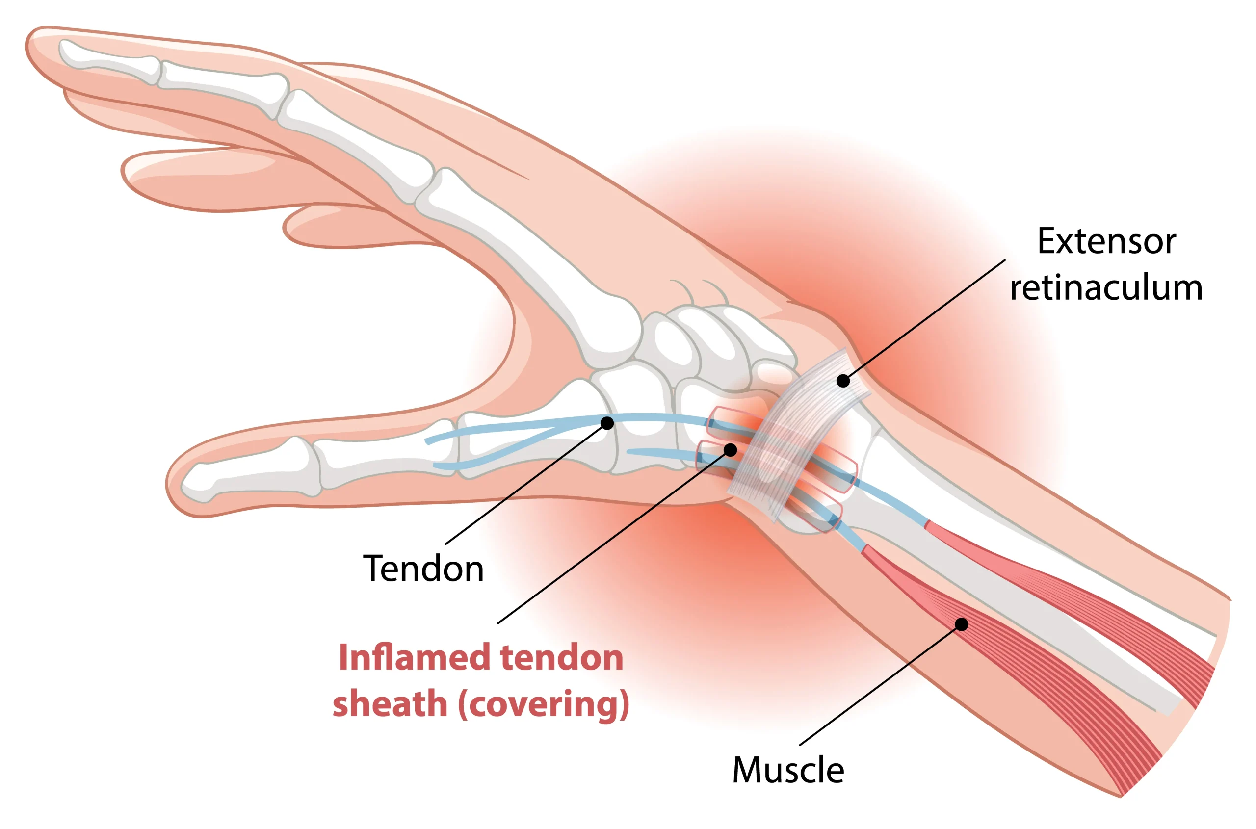 De Quervain’s Tenosynovitis | Oscar