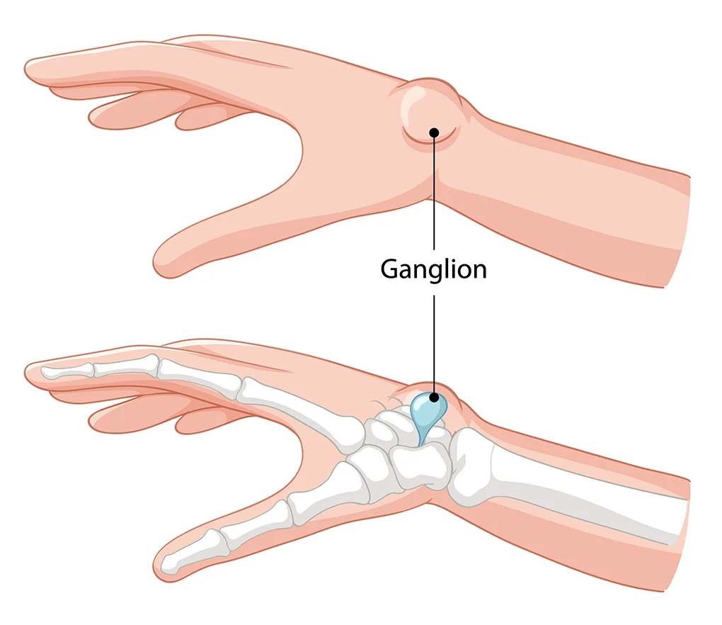 Ganglion Cysts