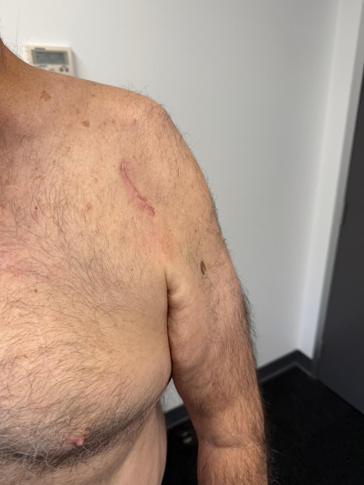 Minimally Invasive Shoulder Joint Replacement Cut