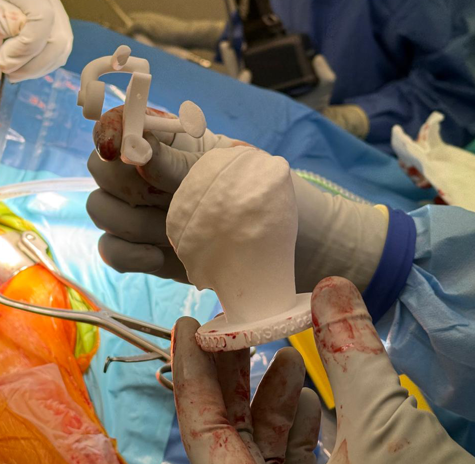 Patient-Specific Instrumentation (PSI) Joint Sample