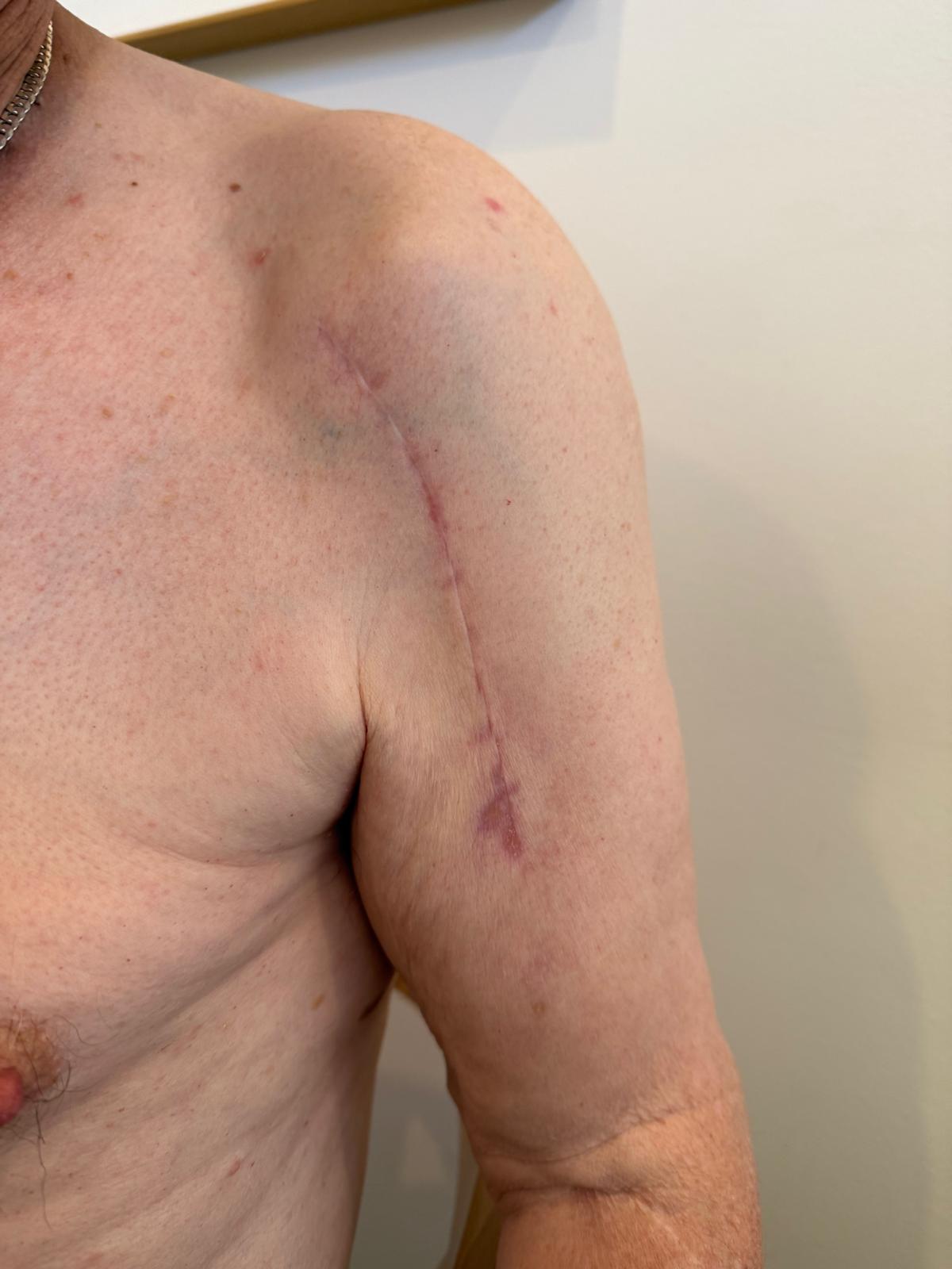 Traditional Shoulder Joint Replacement Cut
